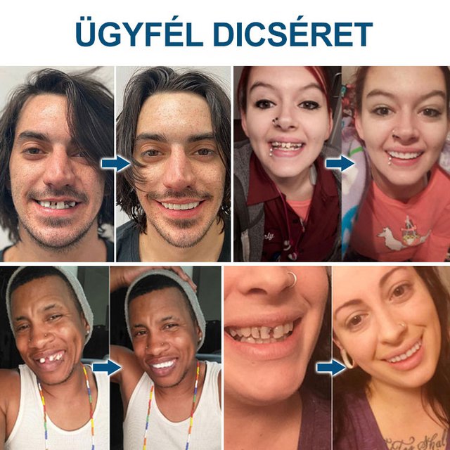 ORALHOE Fogmódosító fogsor fogszabályozó